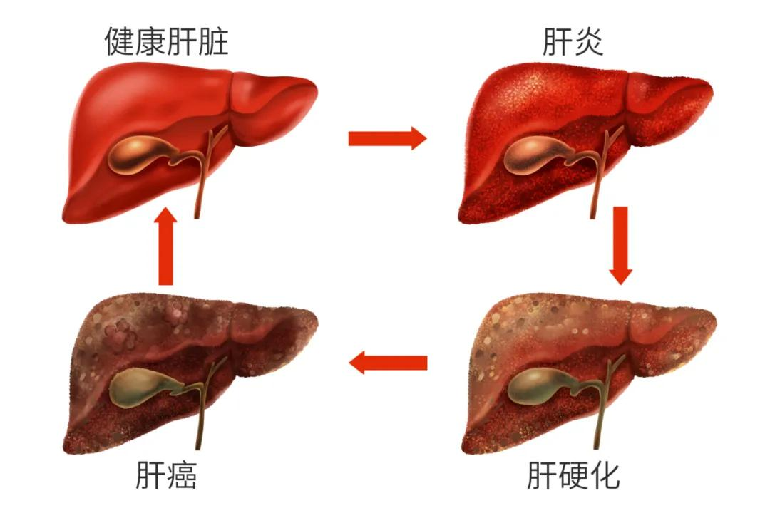 达叔走了，远离肝癌我们能做点什么？